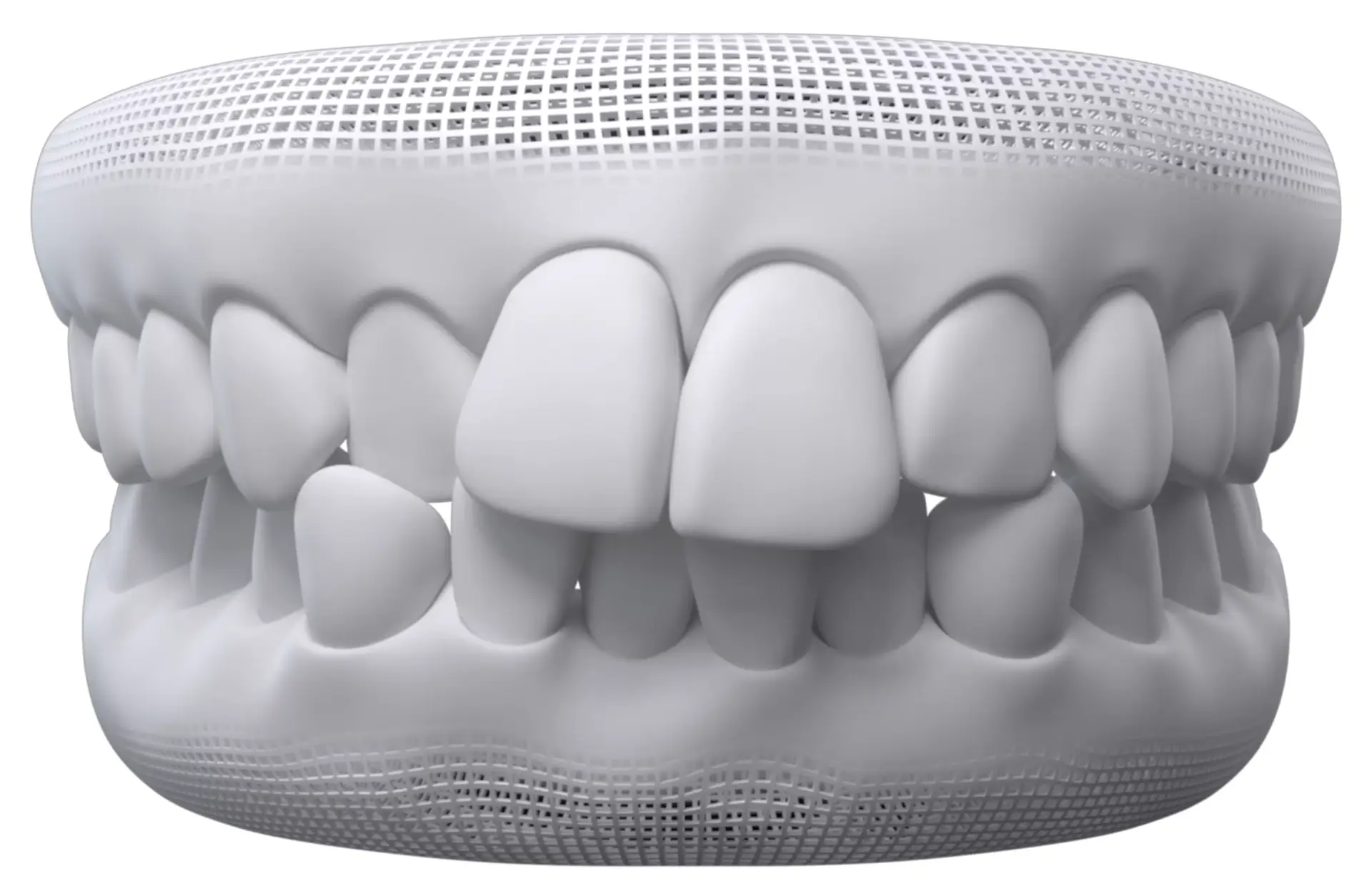 O que é apinhamento dentário?